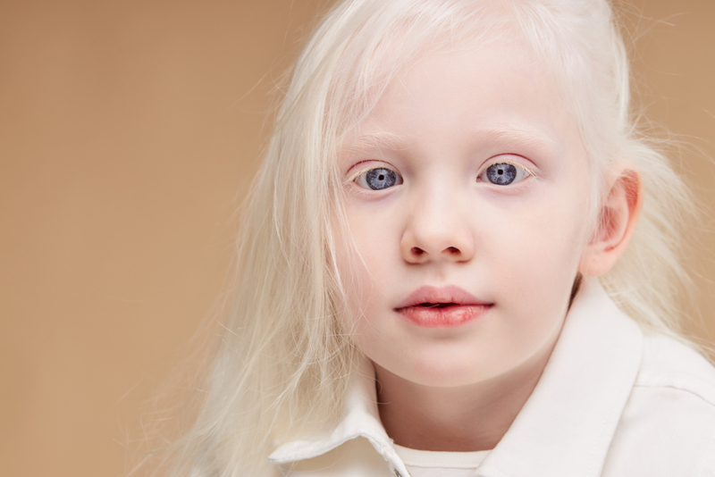 Ocular Albinism Does More Than Reduce Pigmentation | UfaBizPhoto/Shutterstock